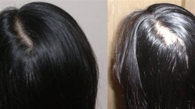 السيروم الأحمر لتقوية جذور الشعر وإنبات الفراغات 