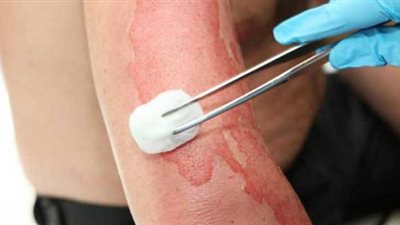 طريقة علاج الحروق البسيطة بالمنزل