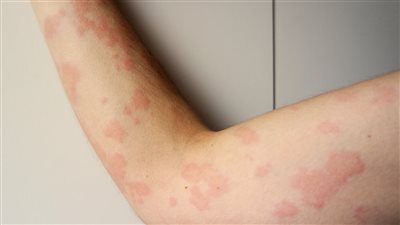 أعراض الأرتكاريا الحادة وطرق الوقاية منها