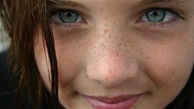 علاج النمش في أسرع وقت بوصفات طبيعية آمنة