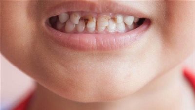 تفسير حلم تسوس الأسنان في المنام وعلاقته بالخلافات الزوجية وعودة الغائب