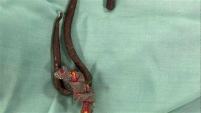 مستشفى أسوان الجامعي يجري عملية لاستخراج سيخ حديدي من فم طفلة 