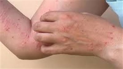 المصل واللقاح تكشف حقيقة ظهور مرض جدري القرود في مصر