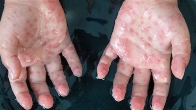 أول حالة يتم تشخيصها خارج أفريقيا، فيروس جدري القرود يصل أوروبا 