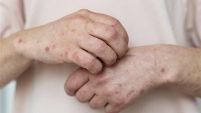 هل يمكن انتشار فيروس جدري القرود في مصر؟ الصحة تجيب 