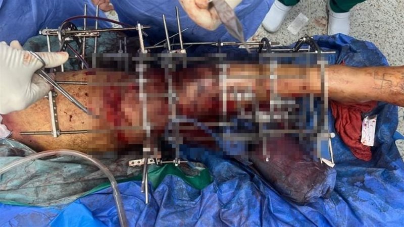 عملية دقيقة في جراحة