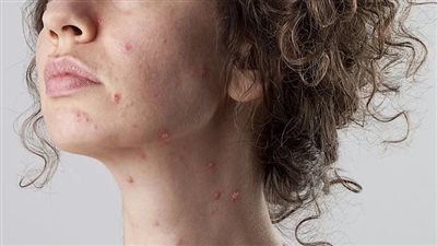 هؤلاء أكثر عرضة لمضاعفات الإصابة بجدري القرود والوفاة 