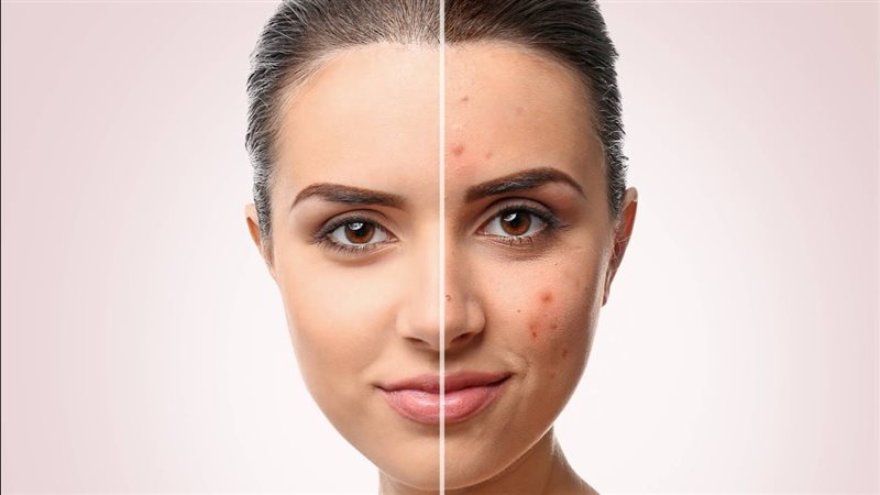 وصفات طبيعية لعلاج
