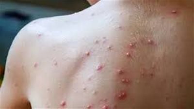 خبير تطعيمات يكشف الفئات المستحقة للتطعيم ضد جدري القرود 