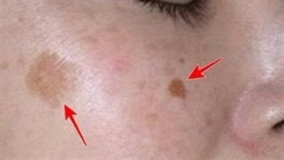 قناع طبيعي يخلصك من البقع الداكنة ويوحد لون البشرة 