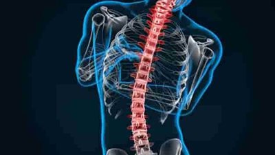  يصيب السيدات وكبار السن، ما هو مرض الجنف التنكسي؟