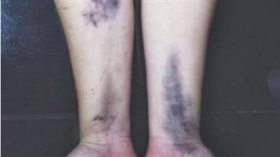 يصاحبها ألم وتورم وسخونة، جمال شعبان يكشف سر انتشار كدمات الزعل 