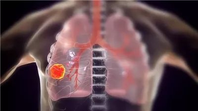  الأعراض والعلامات الصامتة لسرطان الرئة ومتى تبدأ في الظهور؟