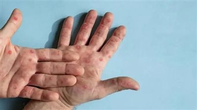  خطة لمواجهة جدري القرود في أفريقيا بـ 600 مليون دولار