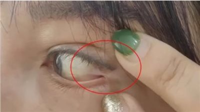 مقطع صادم، التصاق عين سيدة بجفنها بعد عملية تجميل فاشلة (فيديو)
