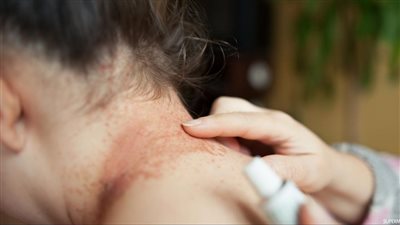 كيف تنتقل عدوى التينيا، وأعراضها وطرق علاجها