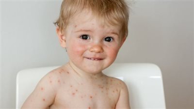 الصحة العالمية: جدري القرود يصيب الأطفال وينتقل من الأم للجنين