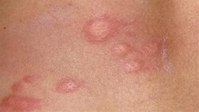 احذري، أمراض جلدية تنتشر فى المدارس بين الأطفال 