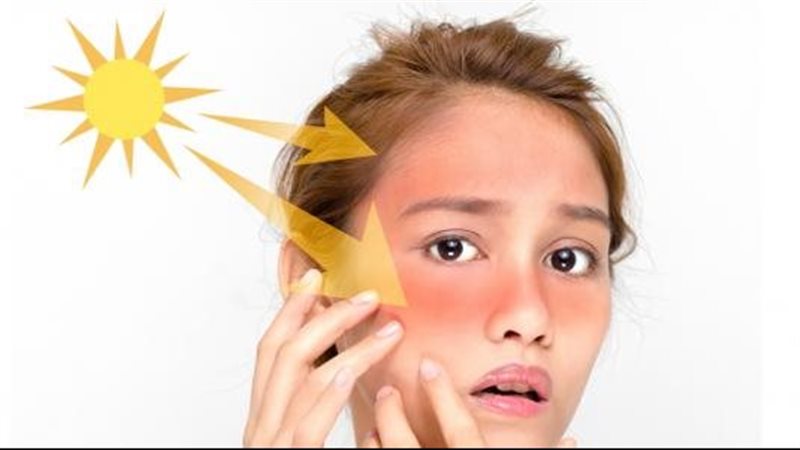 كيفية علاج حروق الشمس،