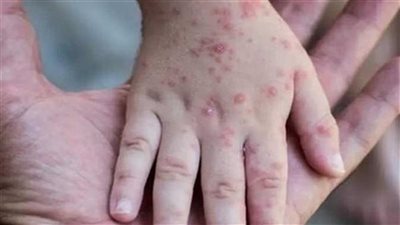 أعراض الجدري لدى الأطفال والبالغين، وطرق علاجه