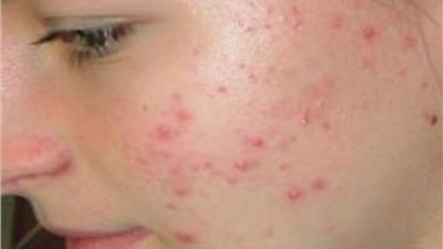 كيفية تقليل الاحمرار والالتهاب الناتج عن حب الشباب 