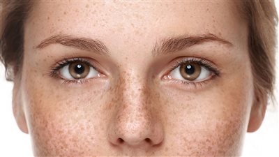 أفضل وأقوى الوصفات الطبيعية لإزالة النمش في أسرع وقت 