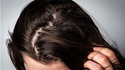 وصفة طبيعية للعناية بالشعر الدهني وتغذيته من الجذور 