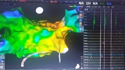 إدخال خدمة علاج مرضى الذبذبة الأذينية بتقنية جديدة في مستشفى القلب الجامعي بأسيوط