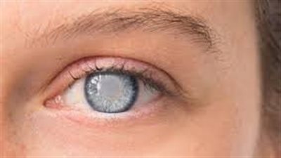 أسباب الإصابة بإعتام عدسة العين مع التقدم في العمر