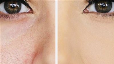 أسباب المسامات الواسعة في الوجه، وطرق علاجها بالوصفات الطبيعية