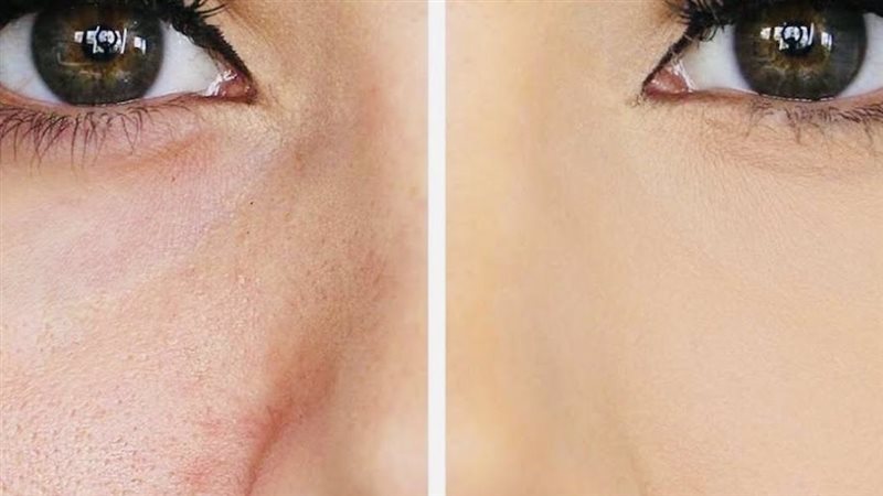علاج المسامات الواسعة