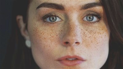 قناع طبيعي لعلاج النمش وآثار حروق الشمس 