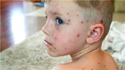  ما هي عدد جرعات تطعيم الجديري المائي وموانع الحصول عليه؟ فاكسيرا تجيب 