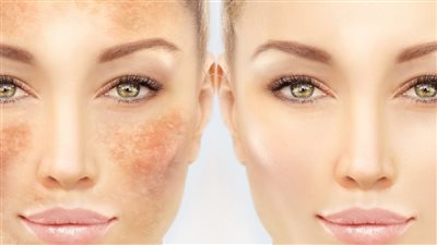 قناع الحلبة يخلصك من البقع بالبشرة ويعيد نضارتها 