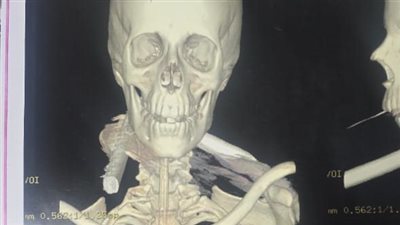 فريق طبي بجامعة أسيوط ينجح في إنقاذ حياة شاب عقب دخول سيخ حديد برقبته 