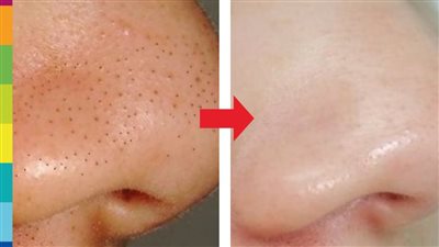 أسرع ماسكات طبيعية للتخلص من الرؤوس السوداء