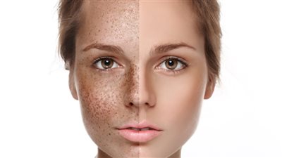 وصفة طبيعية تخلصك من النمش وتعيد للبشرة رونقها
