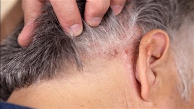 عدوى فطرية تصيب الأطفال، أعراض وطرق علاج تينيا الرأس