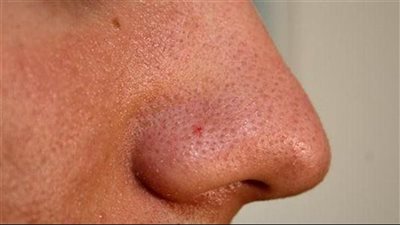 حلقات الطماطم بالسكر لتنظيف البشرة الدهنية وتعزيز نضارتها