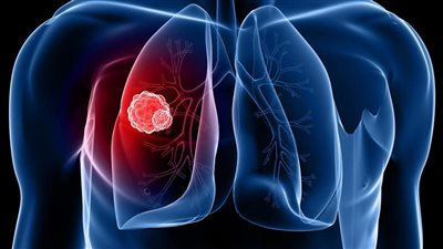 7 أعراض لـ «الالتهاب الرئوي».. احذرها 