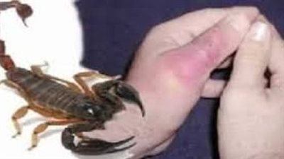 الإسعافات الأولية للتعامل مع لدغات العقارب