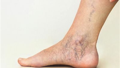 10 علاجات منزلية للتخلص من مشكلات دوالي الساقين المزعجة 