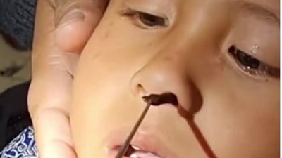 لحظات صعبة، دودة تخرج من أنف طفل (فيديو)