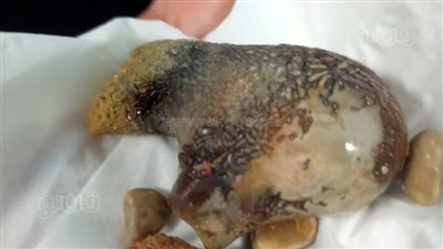 جراحة فريدة لاستخراج حصوة بحجم حجر لمريض قلب بمجمع الأقصر الطبي الدولي