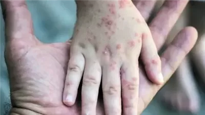 فرنسا تسجل أول إصابة بجدري القرود