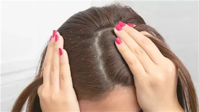 وصفة طبيعية تجنبك الإصابة بقشرة الشعر فى الشتاء 