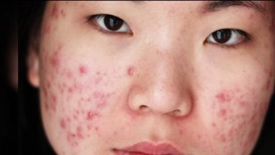 كيفية التخلص من حب الشباب بمكونات بسيطة من منزلك