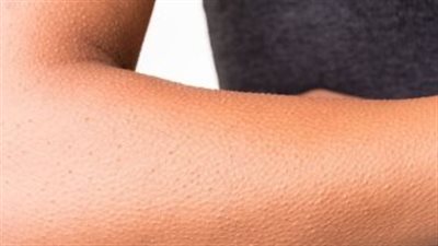 وصفة طبيعية تخلصك من جلد الوزة وتعزز من نعومة البشرة 