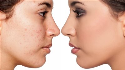 أقوى وصفات طبيعية لعلاج حب الشباب وآثاره