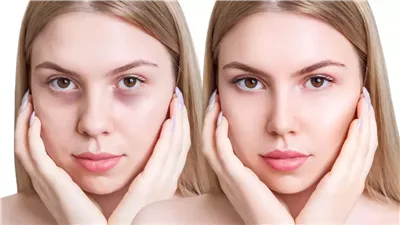 قناع طبيعي يخلصك من الهالات السوداء فى وقت قياسي 